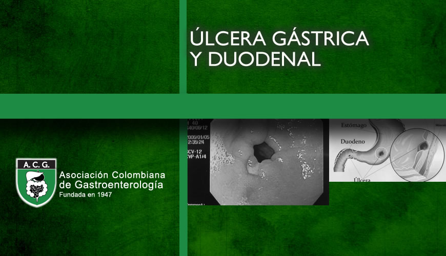 Úlcera Gástrica y Duodenal