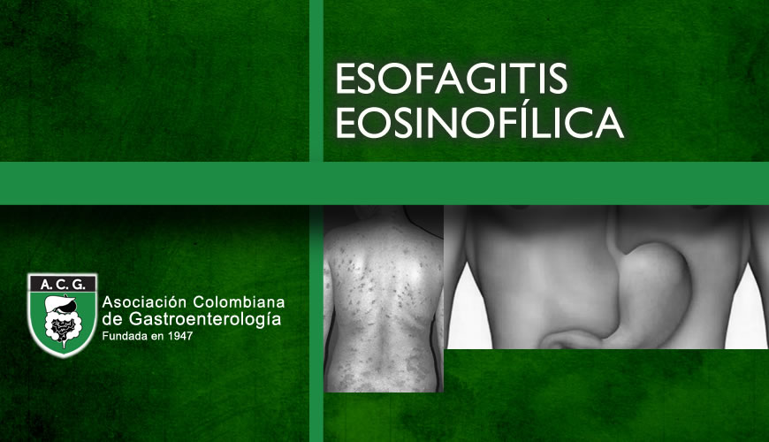Esofagitis Eosinofílica