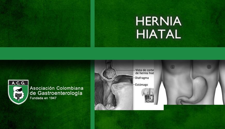 Hernia Hiatal